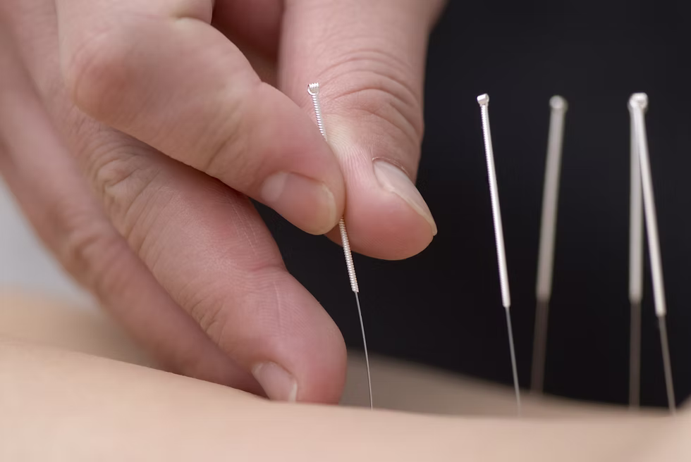 acupuncture-big
